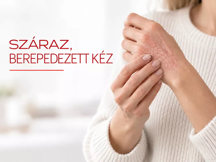 Száraz vagy már repedező kéz ápolása - Dr. Hertelendy CARE