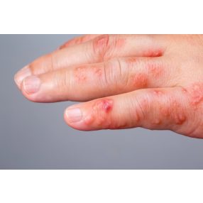 DISZHIDROTIKUS EKCÉMA ÁPOLÓ CSOMAG TENYÉREN