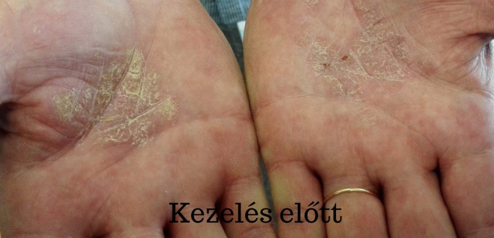 tenyér ekcéma kezelése