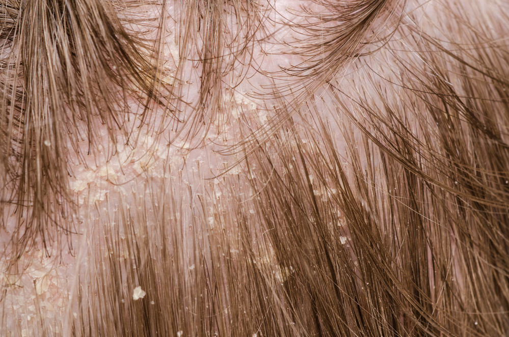 seborrheás fejbőr kezelése piros folt jelenik meg a nyakon és viszket