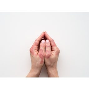 Tenyérekcéma ápolása