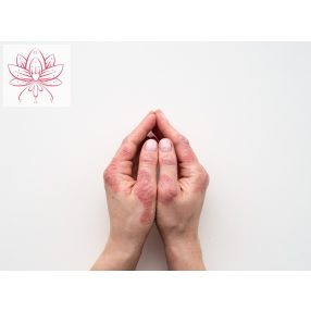 TENYÉREKCÉMA CSOMAG VISZKETŐ - NEM SEBES EKCÉMÁRA