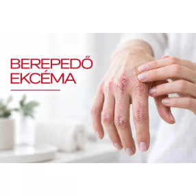 Berepedező ekcéma
