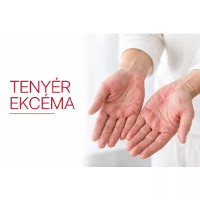 Tenyér ekcéma