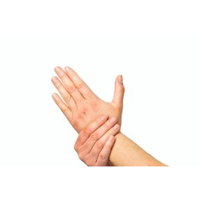 Erősen hámló ekcéma