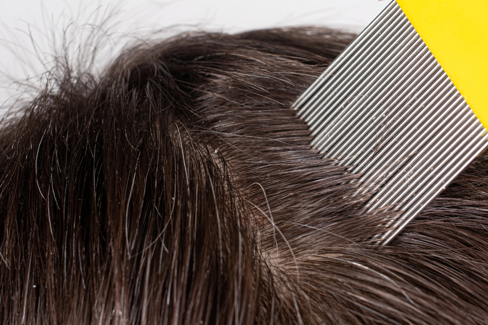 Szabad kaparni vagy fésülni a pikkelysömörös fejbőrt? A plakk-kaparó fésűk valódi hatása