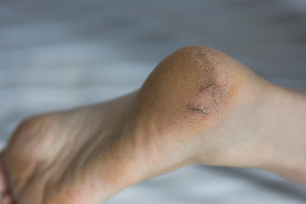 Mély fájadalmas sarokrepedés-miért alakul ki  és mikor kell komolyan venni?