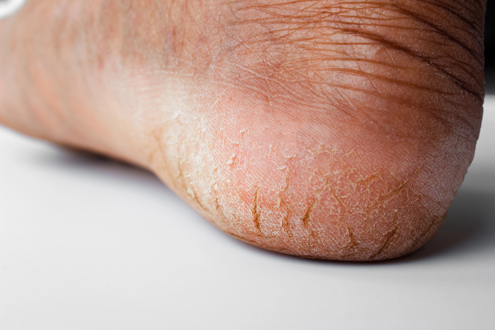 Miért repedezik a sarkam?