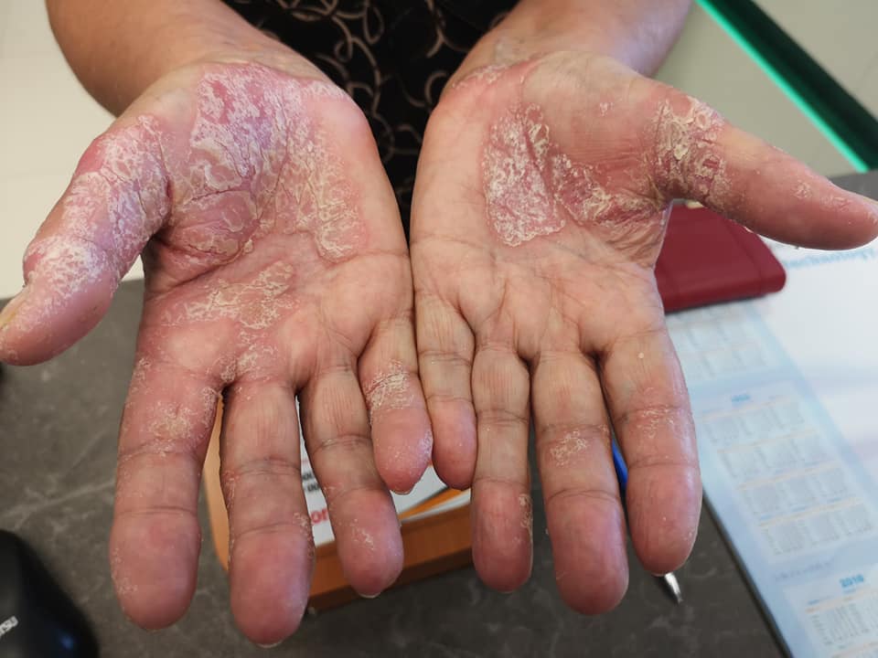 pikkelysömör kezelése kezeken kenőcsök kezét vörös foltok borítják és fájnak