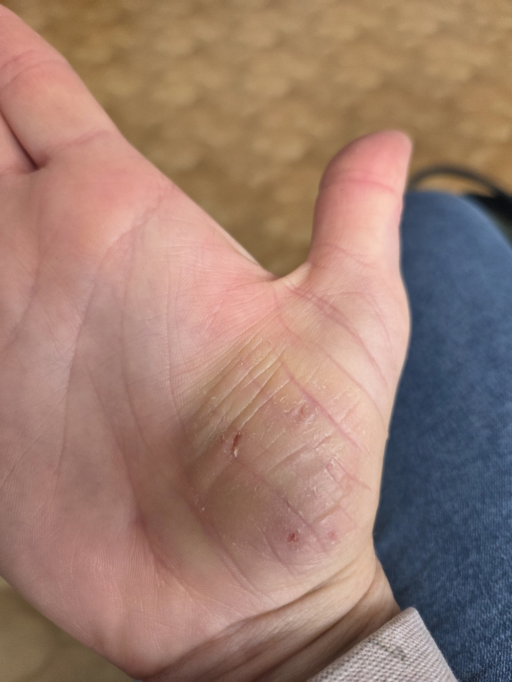 SEBES TENYÉREKCÉMA CSOMAG
