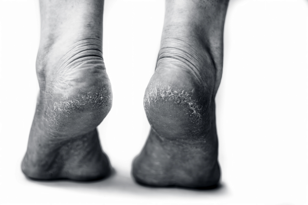 Mikor veszélyes a sarokrepedés- Fertőzés, gyulladás és a fekély kialakulása