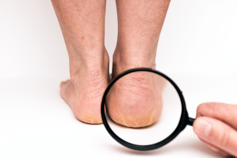 Sarokrepedés külső okai-mechanikai és külső tényezők