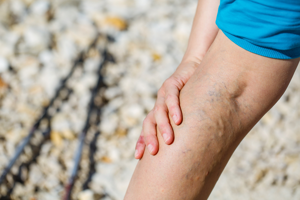 a lábak bőrének visszér visszér fájdalom és tünetek